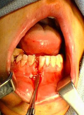 Bar Room Fracture